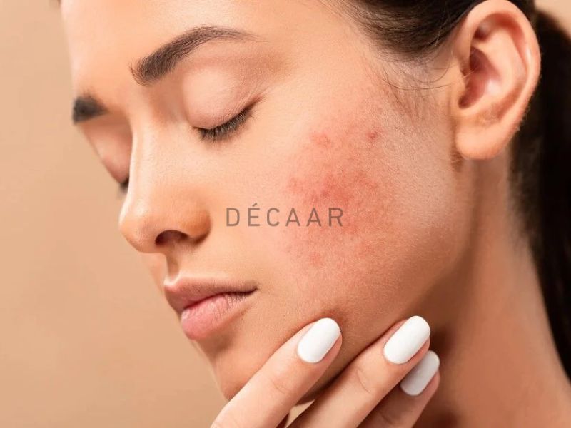 Không nên sử dụng bừa bãi các phương pháp điều trị mụn viêm tại nhà